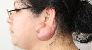 Ear lobe Keloid 