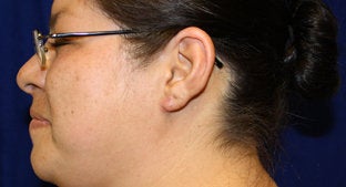 Ear lobe Keloid 