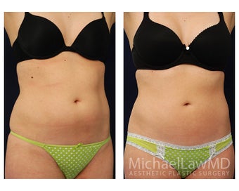 Liposuction