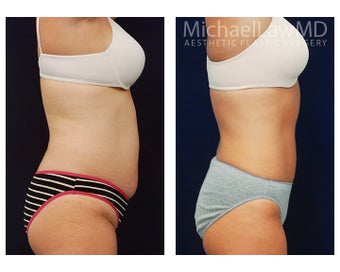Liposuction