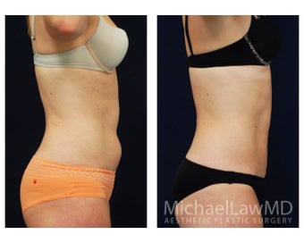 Liposuction