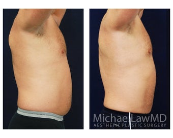 Liposuction