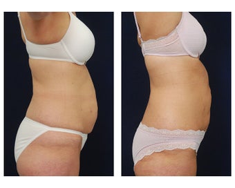 Liposuction