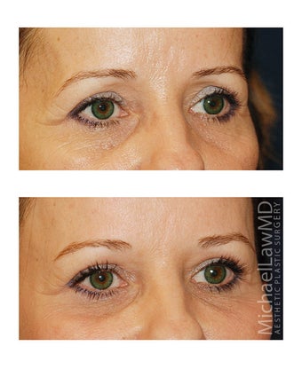 Brow Lift