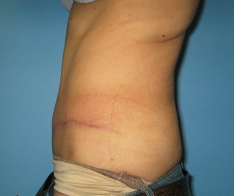 tummy tuck with liposuction