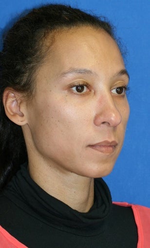 Full Face Fat Transfer