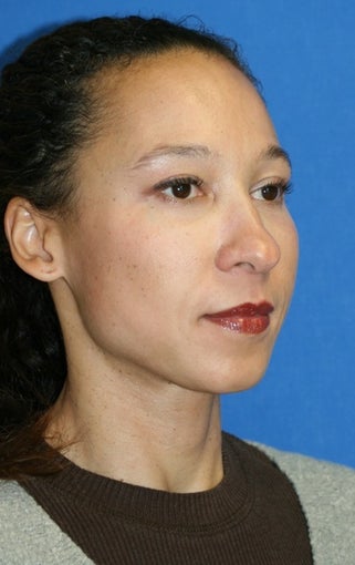Full Face Fat Transfer