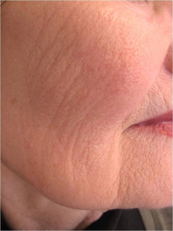 Evolastin- Non Surgical Lift