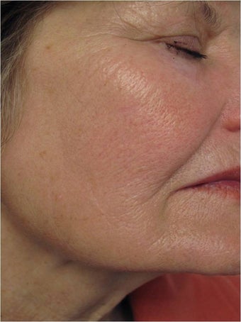 Evolastin- Non Surgical Lift