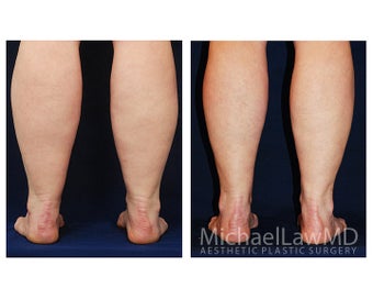 Liposuction