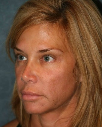 Ultherapy 