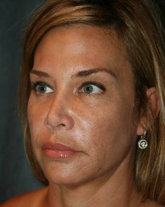 Ultherapy 