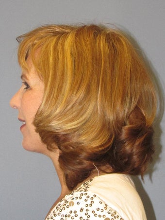Mini Facelift - LiteLift™
