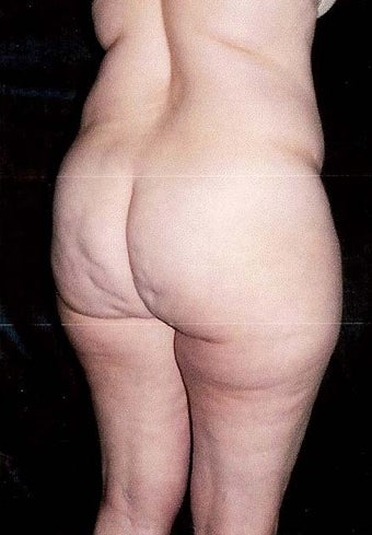 Liposuction