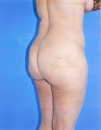 Liposuction