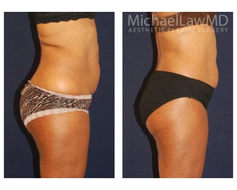 Lower Body Lift