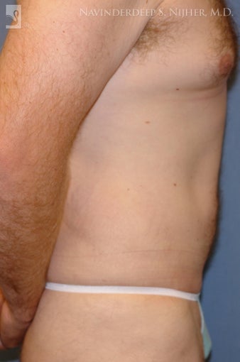 Tummy Tuck