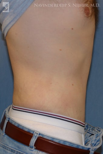 Tummy Tuck