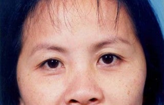 Asian eyelid surgery