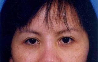 Asian eyelid surgery