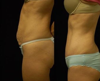 Abdominoplasty