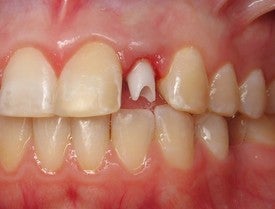 Dental Implant for Missing Lateral Incisor