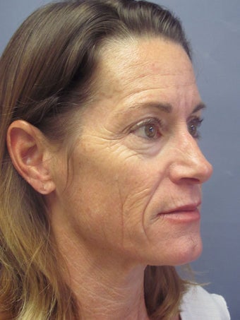 LiteLift