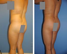 Fat Transfer 