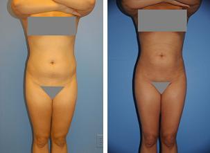 Fat Transfer 