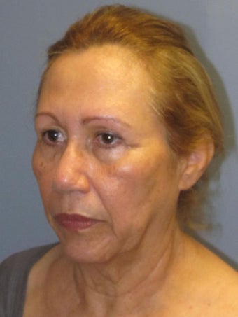 Brow Lift