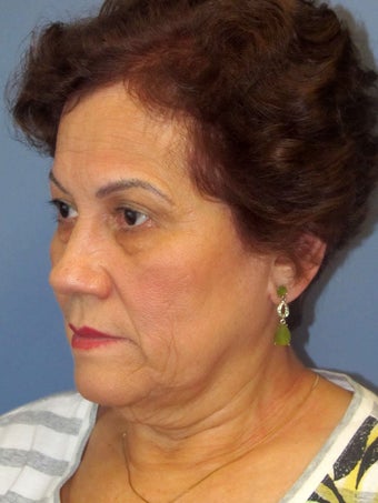 Brow Lift