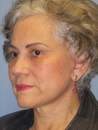 Brow Lift