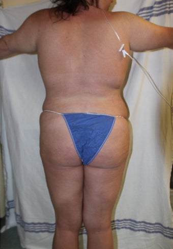 Brazilian Butt Lift