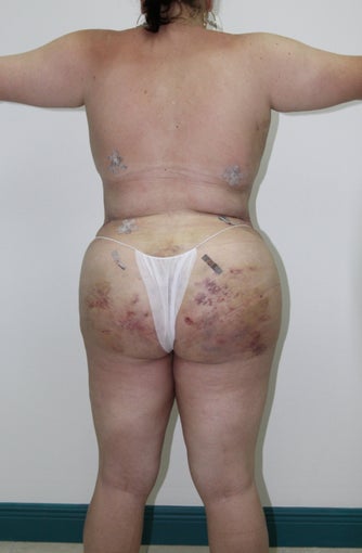 Brazilian Butt Lift