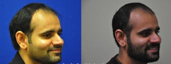 Right Sided Dimple Creation Surgery