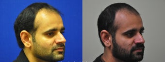 Right Sided Dimple Creation Surgery