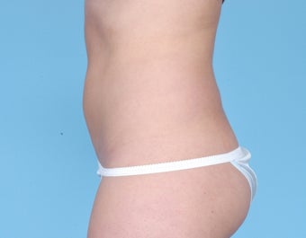 CoolSculpting