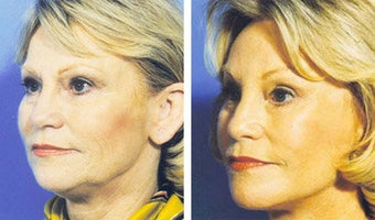 Facelift