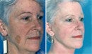 Facelift