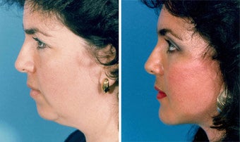 Facelift