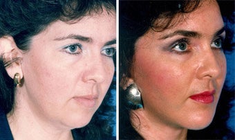 Facelift