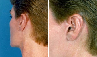 Facelift