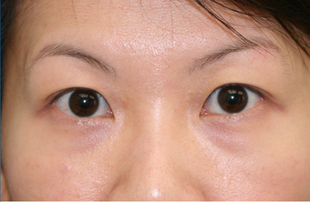 Upper blepharoplasty
