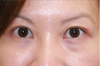 Upper blepharoplasty