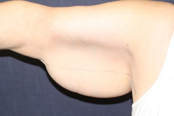 Brachioplasty (Arm Lift)