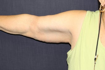 Brachioplasty (Arm Lift)