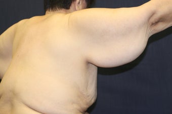 Arm Lift (Brachioplasty)