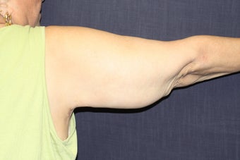 Arm Lift (Brachioplasty)