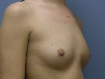 Breast Augmentation