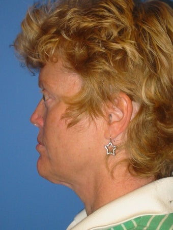 Browlift